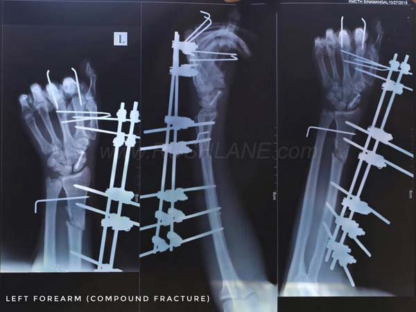 2 साल पहले केटीएम ड्यूक 390 से हुआ था यह खतरनाक हादसा, लेकिन...