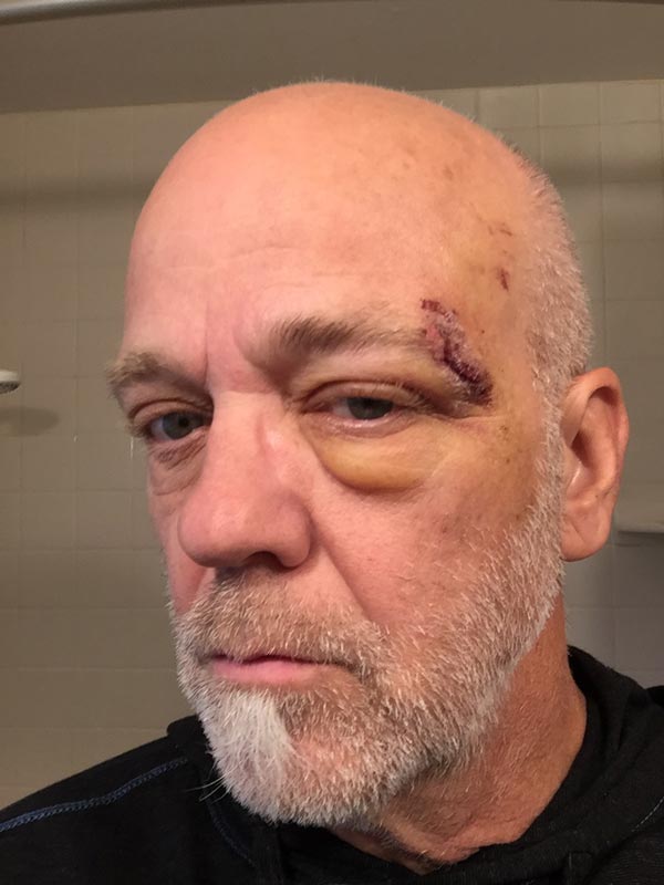 Apple Watch Hard Fall Feature Saves Mountain Biker’s Life; Alerts Emergency Services