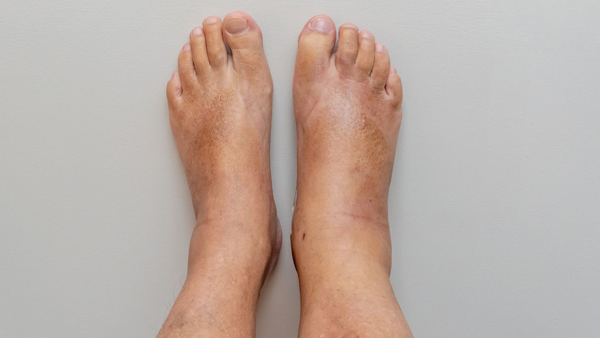 swollen feet