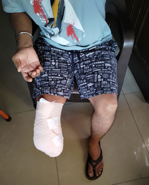 scorpio n owner lost leg accident