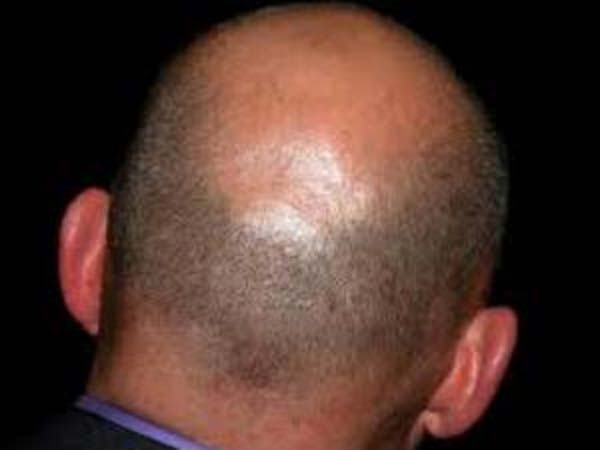 03. பாக்டீரியா பிரச்னை